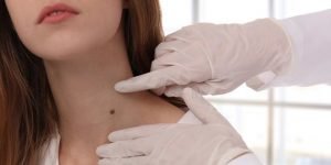 Rekomendasi Obat Penghilang Kutil di Leher dan Tahi Lalat di Wajah