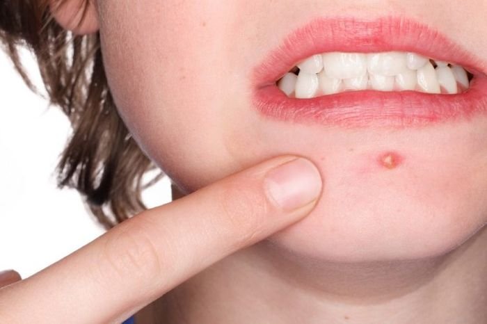 Acne On The Chin, Causes And How To Deal With The Plague