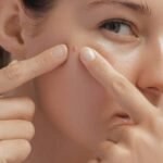 Benjolan Merah di Wajah: Jerawat atau Rosacea?