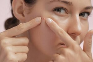 Benjolan Merah di Wajah: Jerawat atau Rosacea?