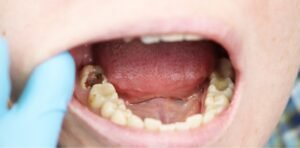 Tanda Bahaya Gigi Butuh Perawatan Akar