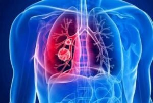 Ciri Fisik Aneh Bisa Tanda Kanker